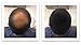 FEBRON Hair Fibers For Thinning Hair LIGHT BROWN Giant 30G For Women & Men Hair Loss Concealer Hair Powder Volumizing Based 100% Undetectable & Natural - Bald Spots Filler