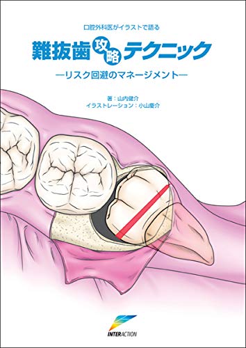 口腔外科医がイラストで語る難抜歯攻略テクニック リスク回避のマネージメント