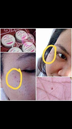 Warts Removal Cream - Get rid of Warts now