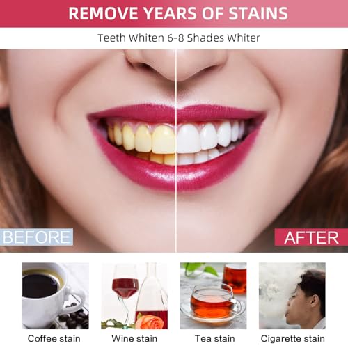 Teeth Whitening Kit - Wired LED Teeth Whitening Set with 5 x 3 ml PAP+ Gel - Direct USB Power Supply without Battery - Professional Teeth Bleaching at Home - More Effective than Whitening Strips