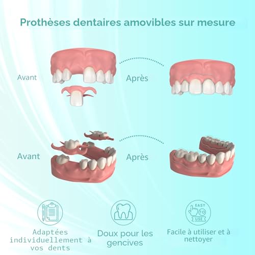 Custom Partial Dental Denture - Temporary Denture, Removable and Temporary Denture. Perfect fit and easy to use to recreate your smile at home (6 teeth)