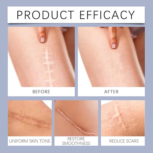 Silicone Scar Cream - Gel for Old and Recent Scars - Night Cream to Remove C-Section Scars, Tummy Tuck, Keloids and Stretch Marks - 50ml