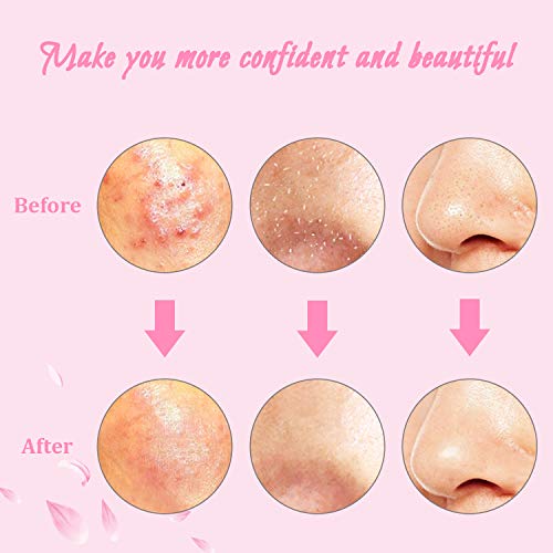 image for HYRIXDIRECT 6 PCS Blackhead Remover Kit Comedone Acne Extractor Blackh