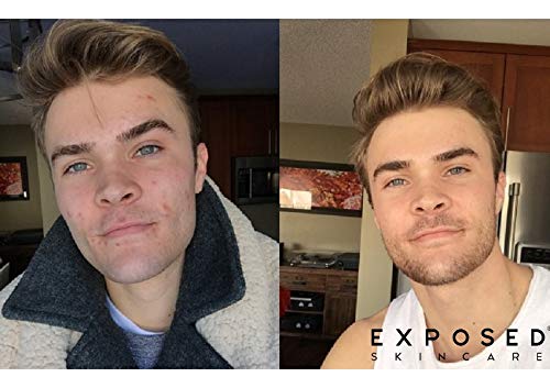 1 Exposed+Skin+Care+Treatment+Formulated