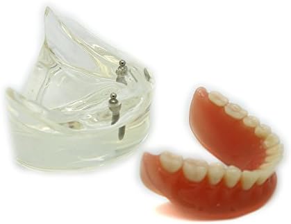 Lanjing New Dental Model Overdenture Inferior with 2 Implants Demo #6002-01
