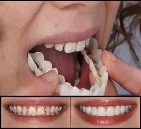 Chaloo,Snapon Smile-The new model simulates the braces (2)