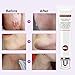 Scar Cream,Scar Removal Cream Gel,Scar Treatment,Scar Repair Cream,Acne Spots Treatment,Scar Gel Remove & Lighten Old & New Scars,Acne Scar Removal Cream,Face Skin Repair Cream