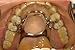 Full Arch Intraoral Photo Dental Mirror - Adult Occlusal Model