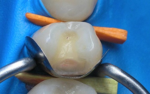 50 of Dental Sectional Contoured Matrices Matrix + 200 Wooden Wedges