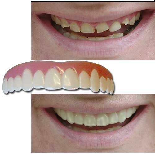 Imako Cosmetic Teeth&reg; Novelty Smile Overlay-Color Natural-Size Small image