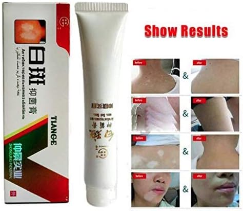 Chinese herbal cream for Vitiligo White Spots Leukoplakia Re Pigmentation