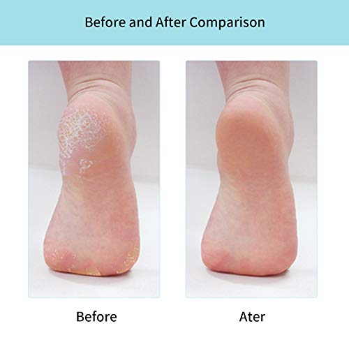 Double Sided Foot Rasp Foot File and Callus Remover to Remove Hard Skin Best Foot Care Pedicure Metal Surface Tool To Remove Hard Skin Surgical Grade Stainless Steel File (BLUE)