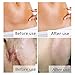 Scar Cream, Scar Treatment, Stretch Mark Cream, Scar Removal Cream, Acne Spots Treatment, Scar Cream for Face & Body, Old & New Scars from Cuts, C-Sections & Surgeries (35g)