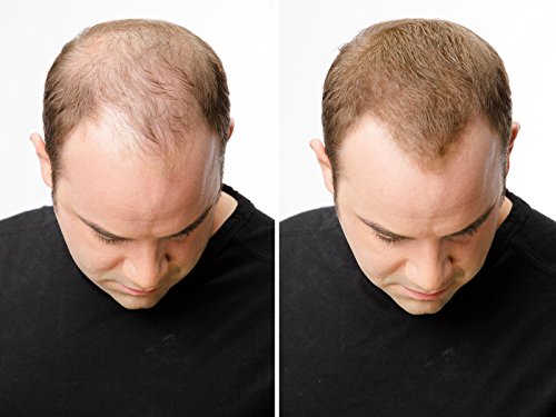 CROWN Hair Fibers - Best Keratin Hair Fibers Instantly Thickens Thinning Hair for Men and Women - Natural Hair Loss Concealer 0.87oz - Dark Brown