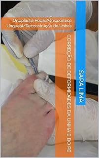 Livro Correção de Deformidades da Unha e do Pé: Ortoplastia Podal/Onicoórtese Ungueal/Reconstrução de Unhas (Pedicure Medicinal Livro 4)