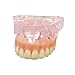 Dentalmall 1 Pc Dental Model #6001 01 - Overdenture Superior with 4 Implants Demo Model