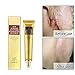 TCM Scar Removal Cream, Acne Treatment Acn Control Acne Scar Removal Gel Skin Repair for Face ear Leg Body Scarring Acne Spots Stretch Burn Scar Remover Marks 30ml (1)