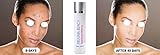 Melasma Bleach Triple Strength Whitening Emulsion 120ml. A Strong Bleaching Cream To Choose When Sun UV Induced Melasma is Present.
