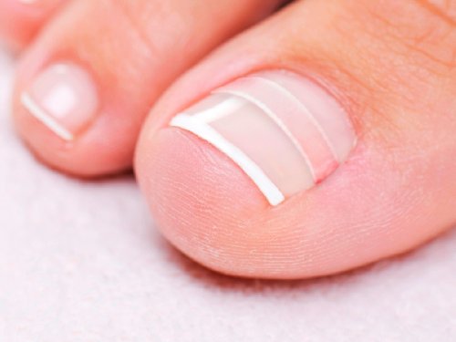 CurveCorrect Ingrown Toenail Home Treatment | Ingrown toenail