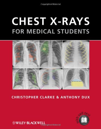 Chest X-rays for Medical Students