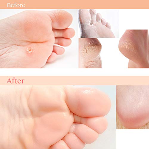 Exfoliating Foot Peel Mask For Softer, Smooth Feet- Gently Peel Away Calluses & Dead Skin, Repair Rough Heels, Get Beautiful Baby Feet in 7 Days (2 Pack) - Thumbnail 5