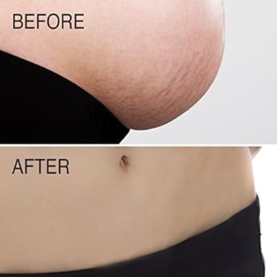 advanced clinicals stretch mark lotion