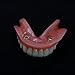 Smile1000 Dental Model Overdenture Inferior 2 Implants Demo for Studing and Teaching