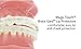 Our Bestseller Orthodontic Braces Lip Guard Protector Shield (1 set - Upper - Lower teeth)