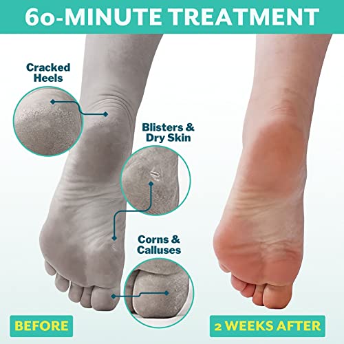 Patchology PoshPeel Pedi Cure Foot Peel Mask Soak Treatment, Pedicure Foot Spa, Feet Peeling