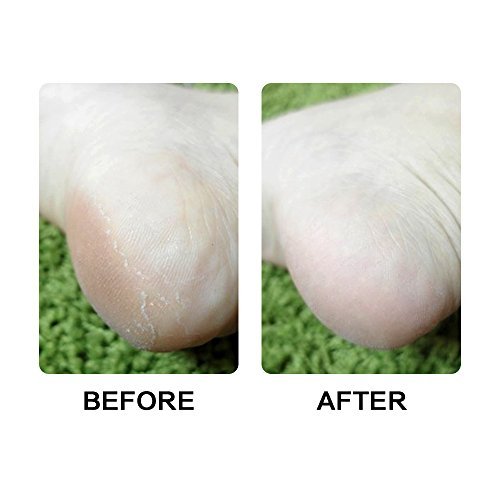 Pedegg power Electric Foot Callus shaver Remover Dry Hard Dead Skin Foot Smoother Pedicure with Diamond Crystals Professional Spa Electronic Micro Pedi Feet Care (red)