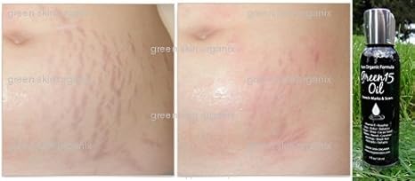 microdermabrasion for stretch marks