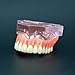 Dentalmall 1 Pc Dental Model #6001 01 - Overdenture Superior with 4 Implants Demo Model
