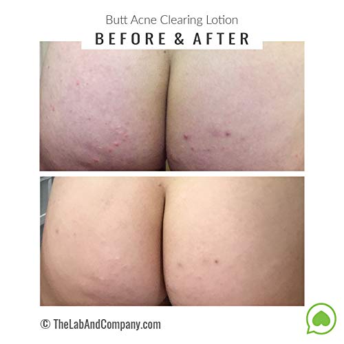 Butt Acne Clearing Lotion 4 Fl Oz In Dubai Uae Whizz Lotions