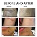 Lancs Acne Scar Removal Serum Skin Repair Essence for Reduces the Appearance of Old & New Scars, Wrinkles, Burns and Recovery Scar Treatment (5ml7 bottles)