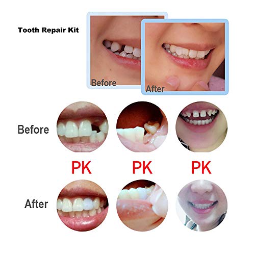 Temporary Teeth Repair Kits Moldable Thermal Fitting Beads for