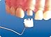 Zubastick Dental Posterior Transparent Crowns Matrices Matrix 64 pcs