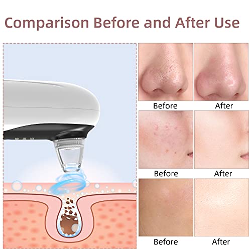 Blackhead Remover Vacuum Pore Cleaner with Camera, VITCOCO Facial Suction Pore Cleaner, Blackhead Extractor Tool Kit for Nose