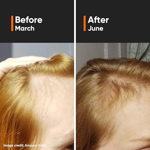 Minimalist Suero para el crecimiento del cabello con Capixyl, Redensyl, Procapil, Anagain y Baicapil | Fortalece el folículo piloso y controla la caída del cabello | Unisex-Adultos | 18 % activos para el crecimiento del cabello