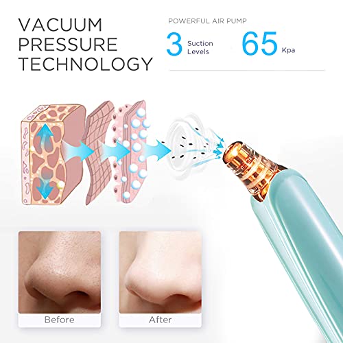 Blackhead Remover Pore Vacuum Cleaner - Upgraded Facial Pore Cleaner -  Electric USB Pore Vacuum with 5 Probes - Upgraded Blackhead Suction Tool -  Blackhead Remover Kit (Viridis) in Kuwait | Whizz