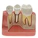 Enshey Dental Implant Analysis Dental Demonstration Teeth Model Crown Bridge Demonstration Teeth 2017