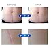 Silicone Scar Gel Away Strips Scar Remover Treatment Strips, Reusable Medical-Grade Silicone Gel Sheets Help to Remove The Old Scars, Acne Scar, Trauma, Burn Scar, hypertrophic Scars.