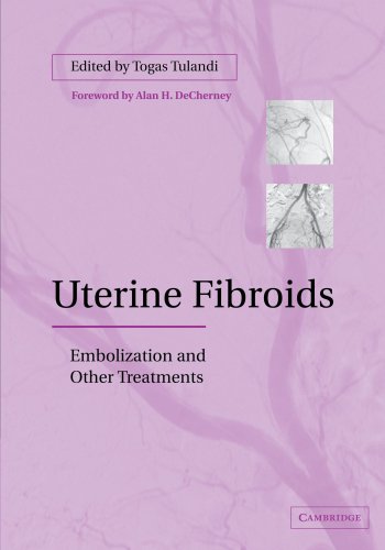 UTERINE FIBROIDS