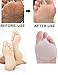Ball-of-Foot Cushions-4 Pieces in one set-Metatarsal Pad For Rapid Pain Relief Neumeria Pads PedPal Kit for Women and Men,Feet Protector Shoe Inserts Helps at work & sports