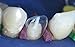 Zubastick Zirconia Alumina Anterior Transparent Crowns Matrices Matrix 64 pcs.