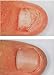 2 Hongosan Best Anti-fungus Fungal Killer Fast Cure the Best Product 4 Cure Nail Hongosan Para Combatir Los Hongos En Las Uñas Mejor Que Zanaquick