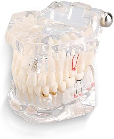 Tooth Model, Disease Teaching Study Adult Typodont Demonstration Teeth Model New