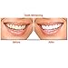 Genkent Teeth Whitening Gel Kit - 44% Carbamide Peroxide, Thermoform Trays, Bonus White Light, Professional Dental Equipment