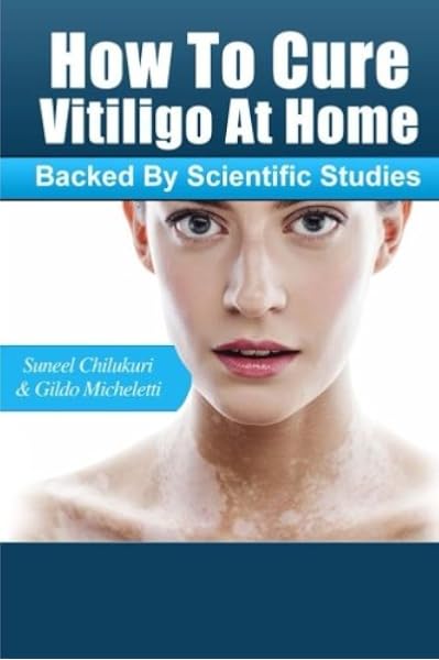 How To Cure Vitiligo At Home Backed By Scientific Studies Chilukuri Suneel Micheletti Gildo 9781537355368 Amazon Com Books
