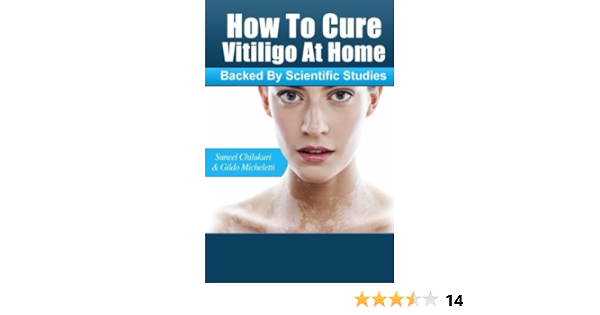 cure vitiligo in 30 days