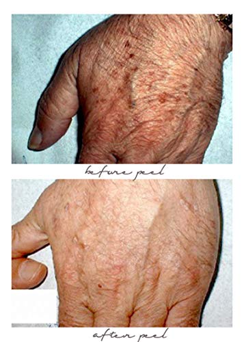 70% Glycolic Acid Skin Peel with Free Fan Brush- Unbuffered Professional Grade